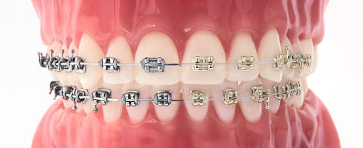 Mouth mold with braces - Garn & Mason Orthodontics in Phoenix, AZ - Queen Creek, Mesa, Chandler, Gilbert
